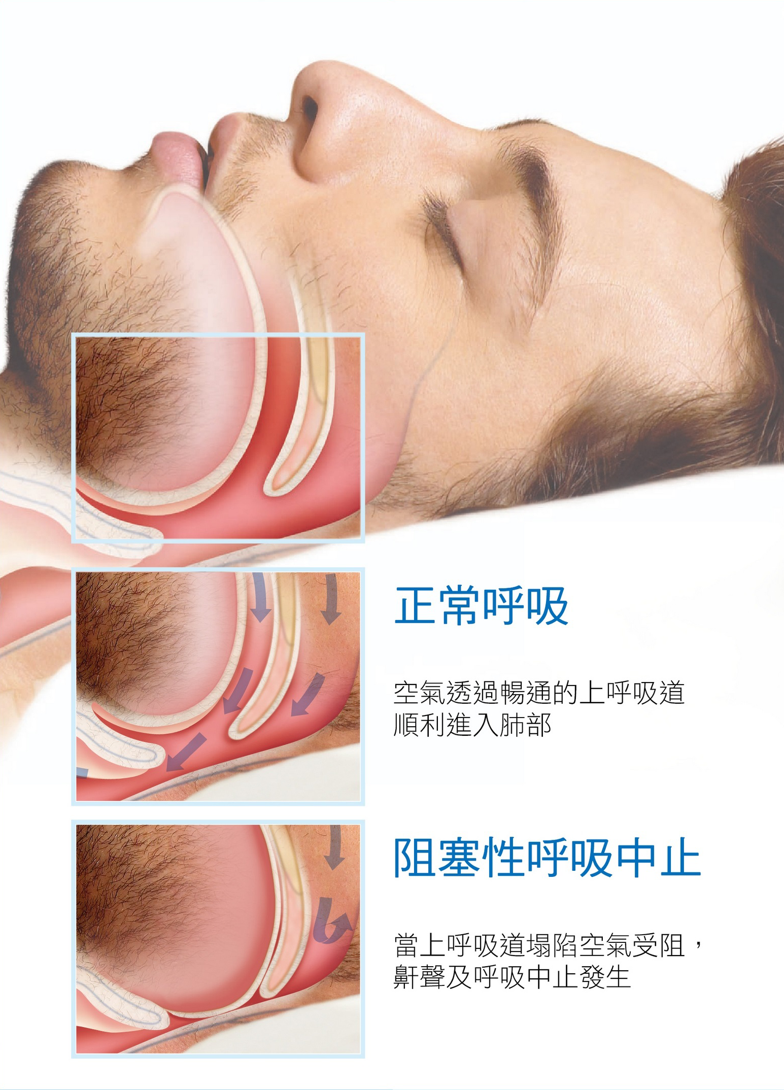 淺談打鼾與睡眠呼吸中止 愛迪生技